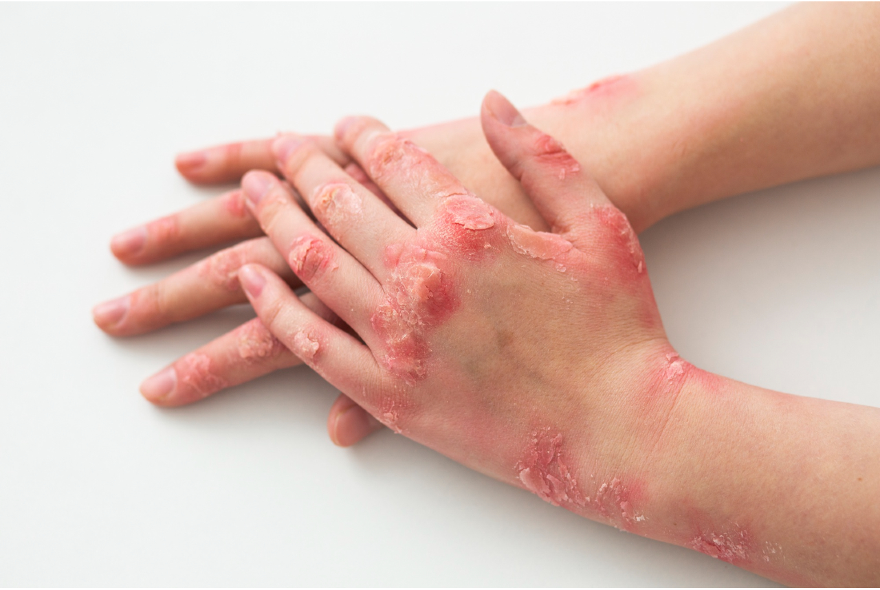 What Are The Causes Of Eczema In Adults Mappels
